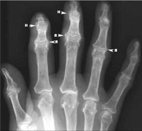 Osteophytes in osteoarthritis of the finger joints in the X-ray image