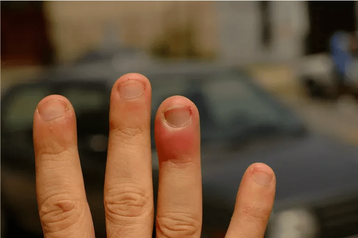 Periungual panaritium causing pain in the finger joints