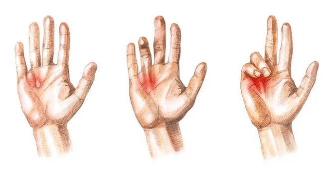 Stages of Dupuytren's Contracture – Inability to straighten the fingers