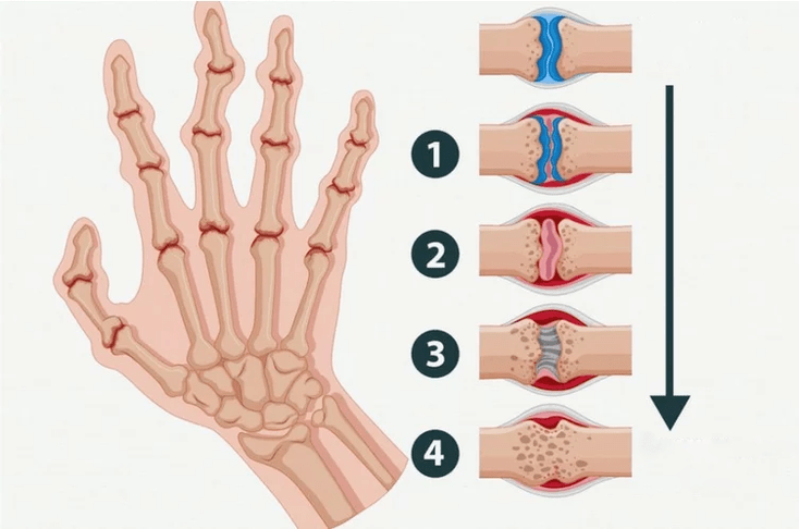 Stages of rheumatoid arthritis affecting the finger joints