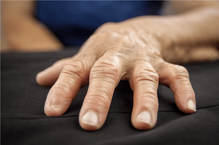 With gout, the knuckles feel warm, swollen and painful. 