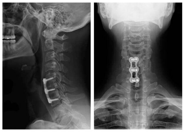 Image after the treatment of vertebrae