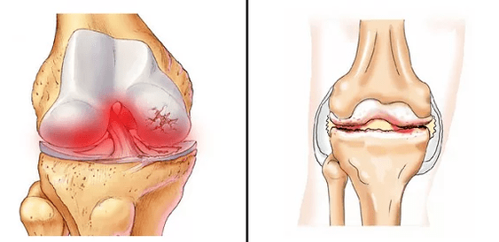 Arthrosis comparison of arthritis