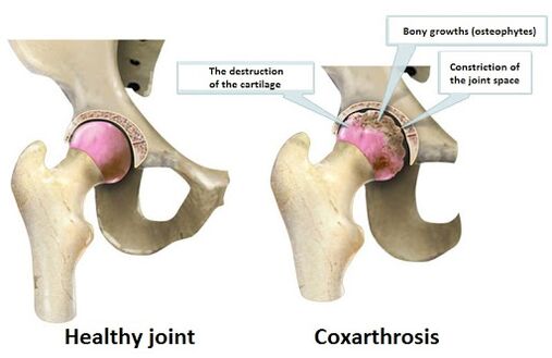 Healthy joint, which is affected by CoksartRosis joint