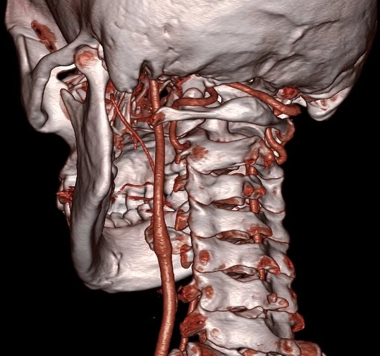 pinched artery with cervical osteochondrosis