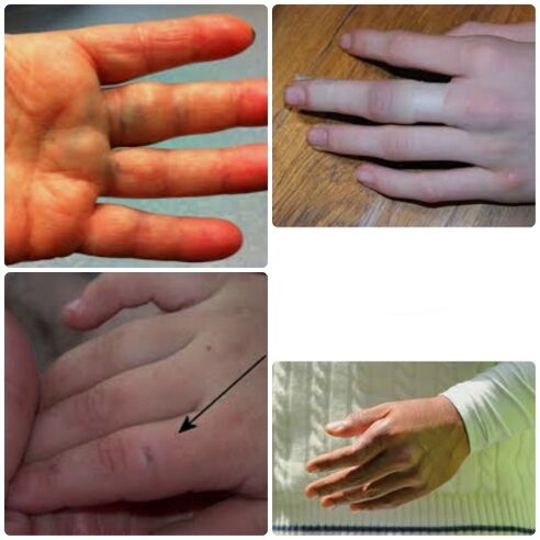 Bruises and fractures of the fingers are characterized by joint pain and swelling