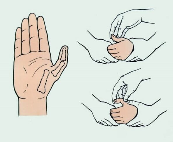 Repositioning of a dislocated finger, necessary to eliminate joint pain