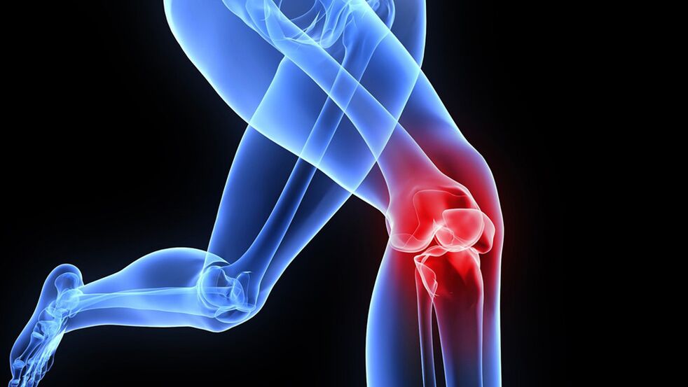 Knee problems due to osteoarthritis