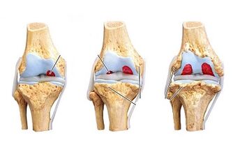Stages of development of arthrosis of the knee joint