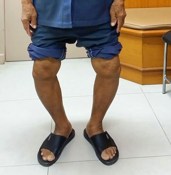 deformed knee joints with arthrosis