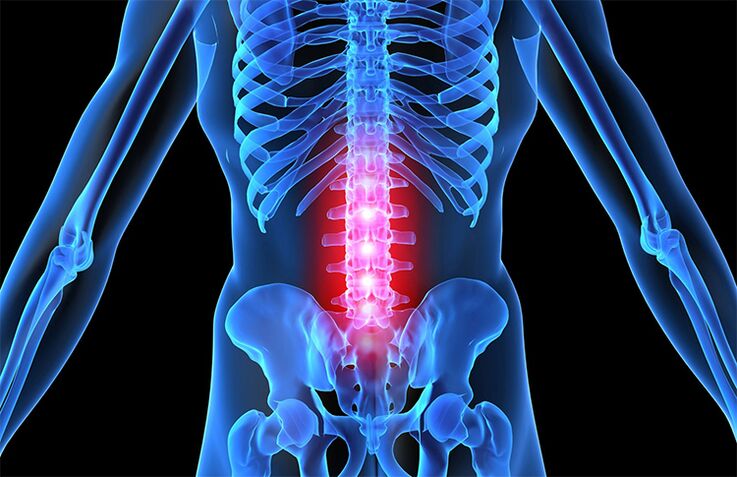 Osteochondrosis of the lumbar spine