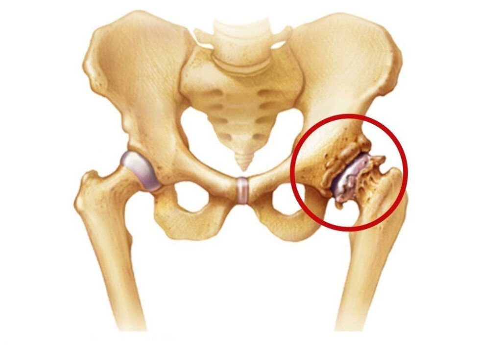 Hip joint affected by osteoarthritis