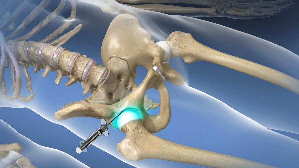 Intra-articular blockade for severe hip arthrosis pain