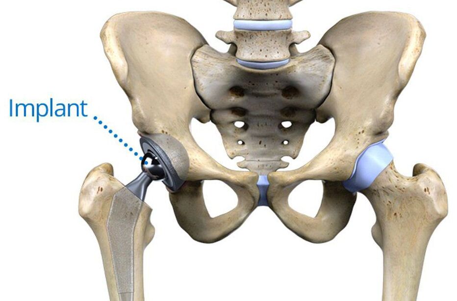 Total hip arthroplasty in osteoarthritis