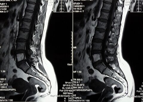 MRI of the lumbosacral spine to diagnose back pain