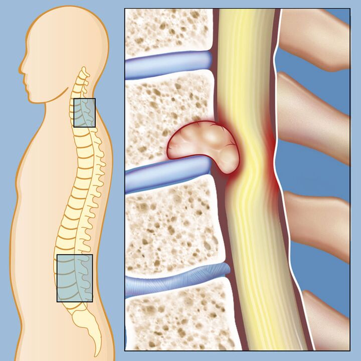 Malignant tumor as the cause of severe lumbar pain